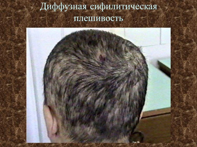 Диффузная сифилитическая плешивость